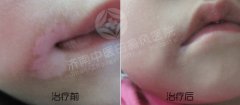 男性是怎样的预防白癜风的