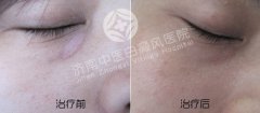 女性白癜风为什么会出现扩散呢