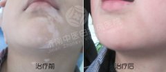 白癜风心理上怎样调节自己的情绪