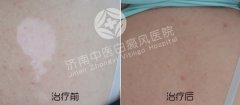 夏季白癜风是怎样出现的