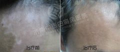 女性得了白癜风应该怎么治疗